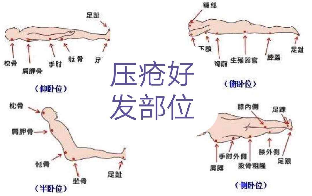 压疮分期最新概述简介